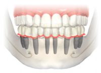 Accesorios para implantes, etc...